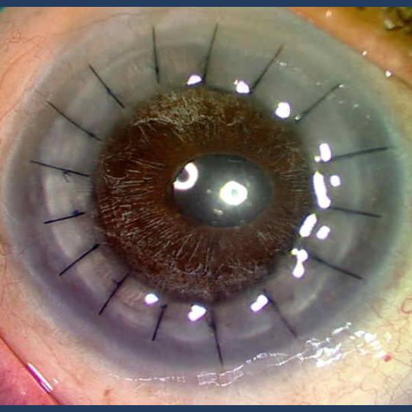 Cornea Transplantation treatment service by Dr. Vidya Bawkar - Cornea Specialist & Opthalmologist in Dombivali, Mumbai