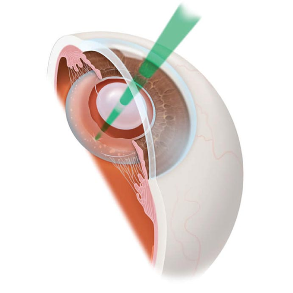 Yag Laser treatment service by Dr. Vidya Bawkar - Cornea Specialist & Opthalmologist in Dombivali, Mumbai